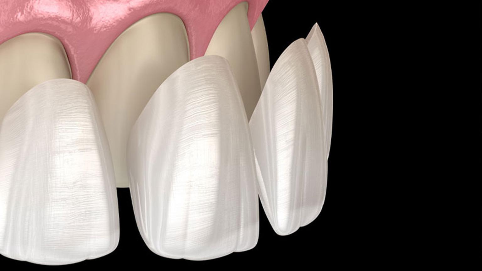 The Versatility of Veneers: Resolving Common Dental Problems