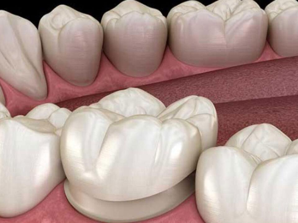 Understanding the Versatility of Zirconia Dental Crowns